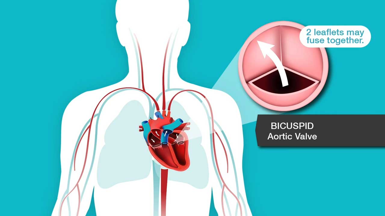 Heart valve - the value in the body, types, prosthetics 41 Heart valve - the value in the body, types, prosthetics 29
